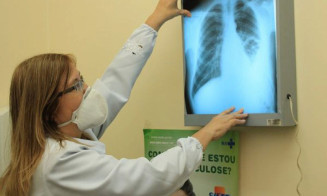 Tratamento mais eficiente no SUS beneficia pacientes com tuberculose