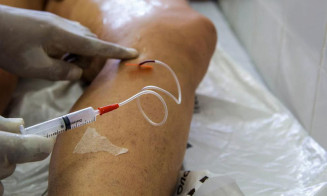 Pandemia fez cirurgias de varizes pelo SUS despencarem 69% no país