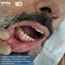 Américas são o epicentro global da epidemia de monkeypox