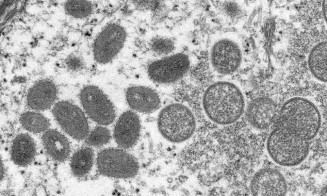 MS tem 61 casos confirmados de varíola dos macacos