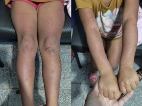 Mãe é presa por colocar filhas de castigo em tampinhas de garrafas