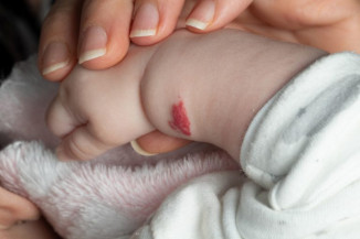 Lei institui Semana de Conscientização sobre Hemangioma e Anomalia Vascular