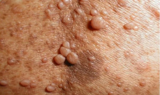 Governo de MS institui Semana de Sensibilização à Neurofibromatose