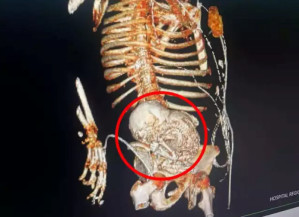 Mulher descobre feto mumificado na barriga: 'Grávida há 56 anos'