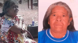 Feto calcificado estava alojado fora do útero e mulher suspeitava de tumor