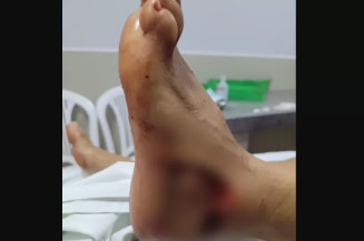 Turista é atacado por peixe Dourado no pé e caso é avaliado como acidental