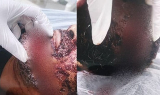 Homem que teve mão amputada pela esposa morre no hospital