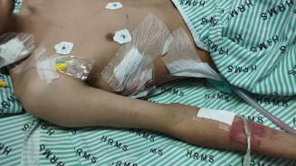 Jovem com dreno para retirar o líquido do pulmão (Foto: Arquivo Pessoal)