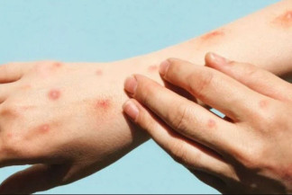 Campo Grande registra 6 casos confirmados de Mpox; saiba mais - Divulgação OPAS