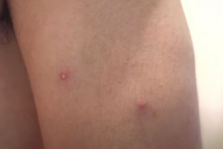 MS tem 9 casos de Mpox confirmados