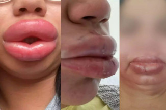 Polícia cumpre mandados contra estudante de biomedicina que oferecia ‘Boca da Angelina Jolie’