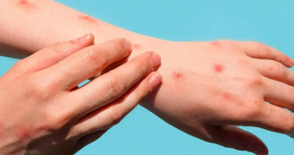 MS registra o 12º caso de mpox
