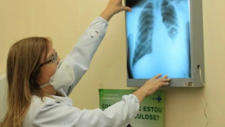 Brasil está na contramão da meta da OMS para extinção da tuberculose