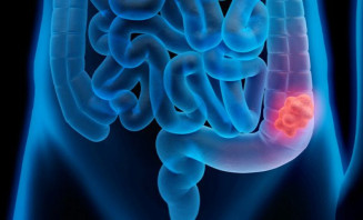 Especialista alerta que rastreamento de intestino deve começar aos 45 anos