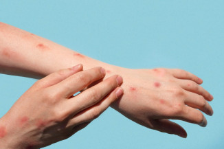 Brasil regista primeiro caso de nova cepa de mpox