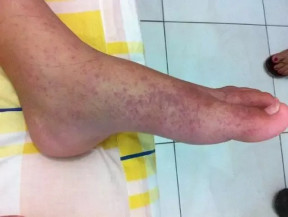 Erupção avermelhada na pele é um dos sintomas da doença