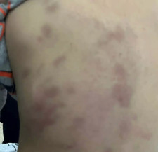 Criança teve várias marcas pelo corpo após a agressão - Foto: Divulgação