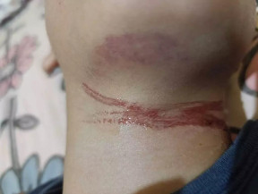 Menino de 10 anos se enrosca em fio solto e fica ferido em Rio Brilhante