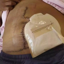 Paciente mostra resultado de nova cirurgia após esquecimento de gaze - Foto: Arquivo pessoal