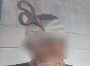 Jovem ficou com a tesoura cravada no rosto. (Reprodução)